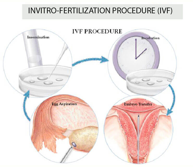 IVF treatment Singapore, IVF clinic, IVF doctor